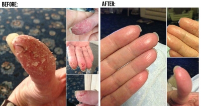 Eczema Sense Real Help For Those Suffering With Eczema