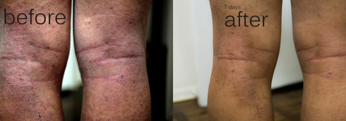 Before and After using steroids for eczema